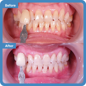 Teeth Whitening
