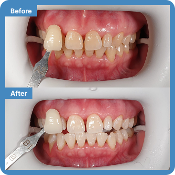 Teeth Bleaching