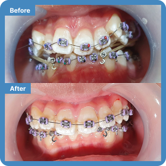 Braces