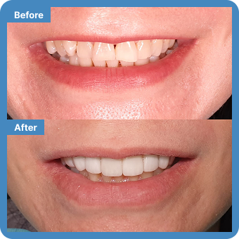 Teeth Whitening