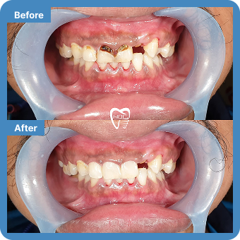 Full Mouth Aesthetic Restoration