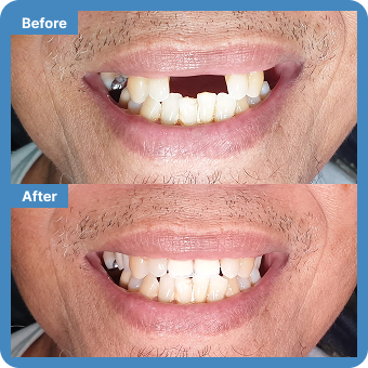 Dental Implant + Crown