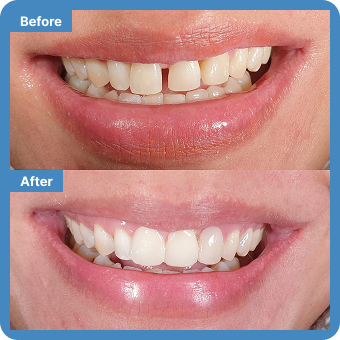 Composite Bonding + Whitening