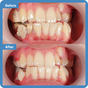 Porcelain Veneer