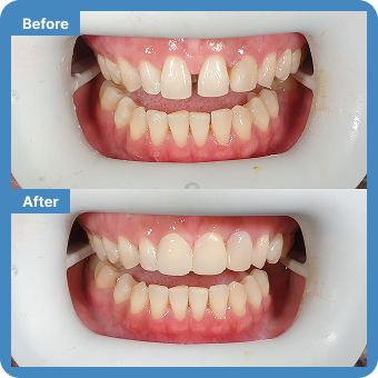 All-on-4 Implants/Bridge