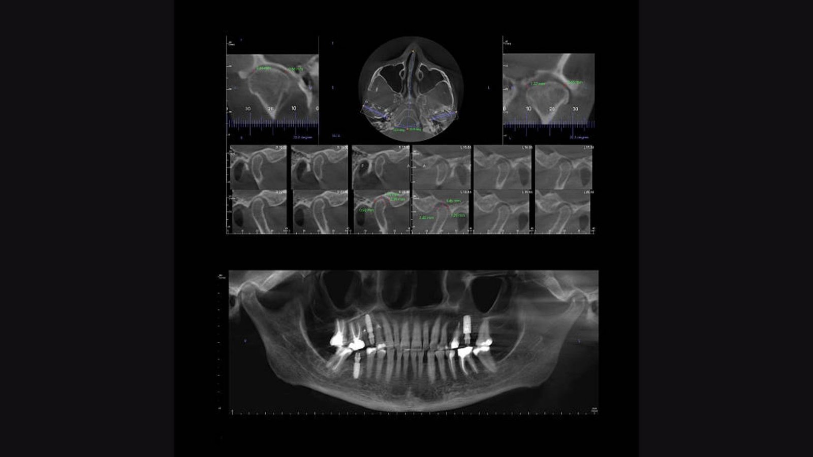 CBCT 3D Cirebon: Teknologi Pemeriksaan Gigi Modern untuk Diagnosis Lebih Akurat