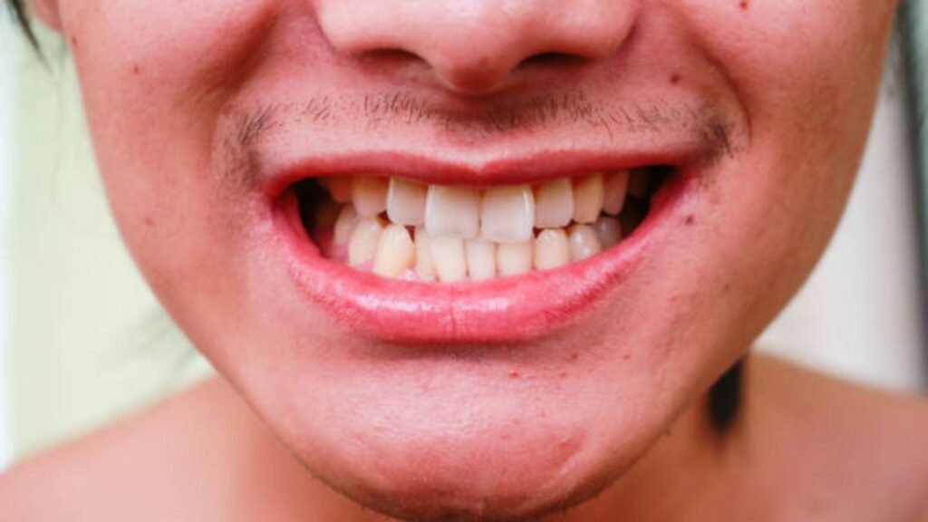 mengatasi gigi kuning